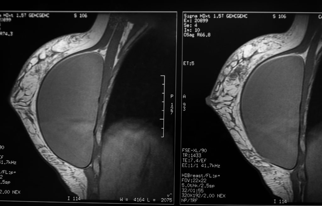 Mammary,Prosthesis,Xray | Explant Surgery