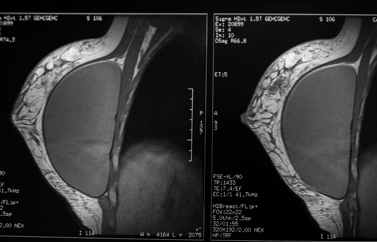 is-it-time-to-recognize-breast-implant-illness-as-a-medical-condition